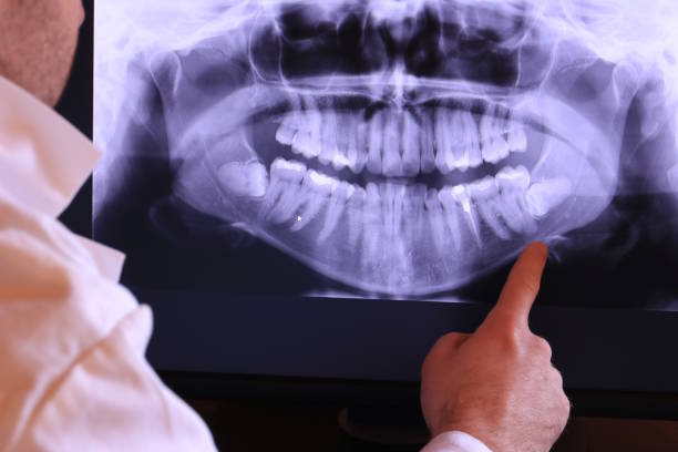 Best Emergency Tooth Extraction in Huntsville, TX